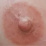 Medische Tepelpigmentatie